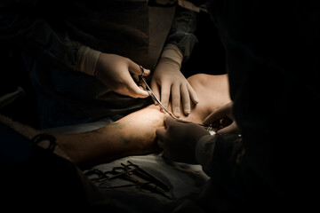 Close-up of hands inserting fiber into vein during laser vein ablation. Endovenous procedure in...