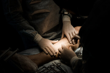 Real-time EVLA guided by duplex ultrasound. Close-up of catheter advancement into vein by vascular...