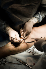 Close-up of surgeon inserting laser fiber into leg vein during EVLA procedure under ultrasound...