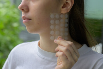 Close up of a young woman holding a transparent pimple patch set near her acne prone cheek. Concept...