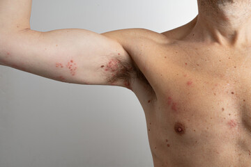 Close up of a man's torso and arm, revealing a painful and itchy rash caused by herpes zoster, commonly known as shingles, highlighting the skin's irritated condition