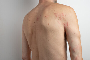 Man is displaying the effects of the herpes zoster virus, commonly known as shingles, with visible blisters and redness on his back and arm, a condition causing pain and discomfort