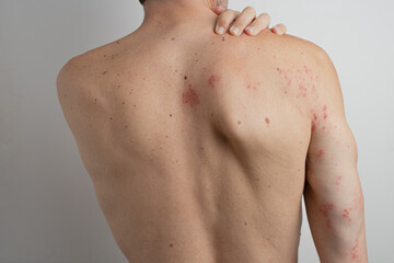 Caucasian male scratching his back and shoulder suffering from chickenpox virus, herpes zoster, shingles, varicella zoster virus with skin rash and blisters