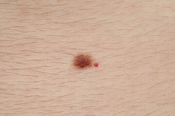 Man with moles on his body, closeup