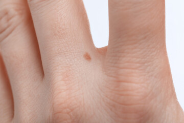 Woman with mole on her hand against white background, closeup