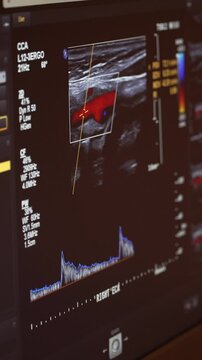 Vertical shot: Carotid artery ultrasound examination on a monitor.