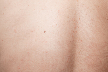 Close-up of human back showing natural skin texture and moles.