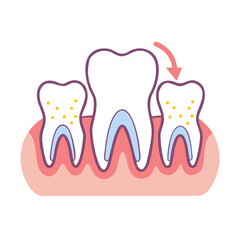 Illustration of tooth decay spreading on a human molar