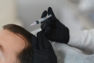 Side view of handsome man getting hair treatment at beauty salon. Man having mesotherapy session at...