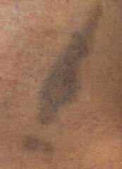 A person has a dark spot on their arm