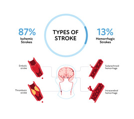 Brain neural disease for healthcare infographic. Vector flat illustration. Embolic, thrombotic, subarachnoid and intracerebral hemorrhage stroke with probability in percent. Design for health care