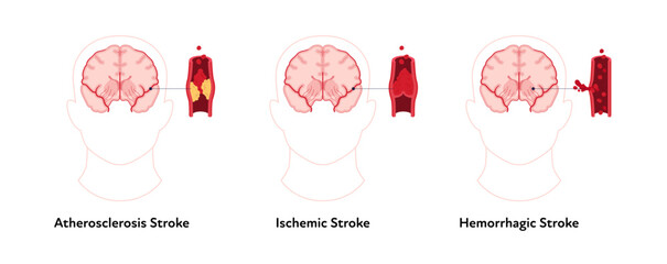 Brain neural disease for healthcare infographic. Vector flat illustration. Atherosclerosis, ischemic, hemorrhagic strokes. Brain front view with vessel, blood clot. Design for health care, education