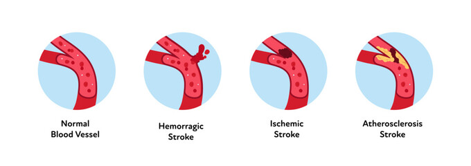 Brain neural disease for healthcare infographic. Vector flat illustration. Atherosclerosis, ischemic, hemorrhagic strokes. Side view blood vessel. Design for health care, education