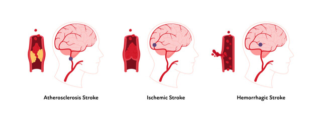 Brain neural disease for healthcare infographic. Vector flat illustration. Atherosclerosis, ischemic, hemorrhagic strokes. Brain side view with vessel, blood clot. Design for health care, education