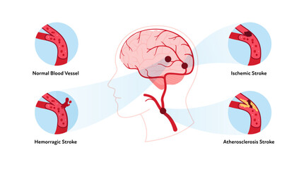Brain neural disease for healthcare infographic. Vector flat illustration. Atherosclerosis, ischemic, hemorrhagic strokes. Brain side view with normal and ill vessel. Design for health care, education
