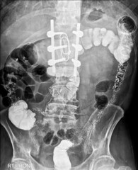Double contrast barium enema showing  mild scoliosis in the lumbar spine, and a few diverticula in the right side colon. There are no signs of bowel obstruction.