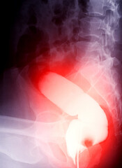 A diagnostic barium enema image showing the presence of diverticulosis in the transverse and ascending colon, demonstrating the typical diverticular formations.