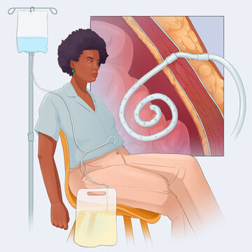 Medical illustration of a Black woman undergoing peritoneal dialysis