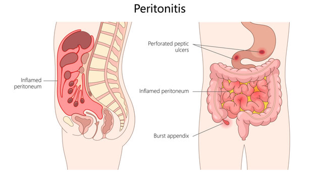 internal inflammation from peritonitis, highlighting burst appendix structure diagram hand drawn schematic vector illustration. Medical science educational illustration