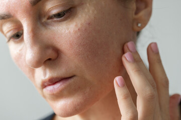 Womans face after beauty injections. Cosmetology procedures.