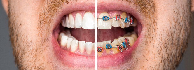 Closeup man with teeth before and after braces treatment. Dental braces, correcting teeth