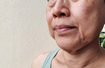 portrait the Flabbiness and wrinkle beside the mouth, dark spots and blemish, freckles and scar on the face of the woman, health care and beauty concept.