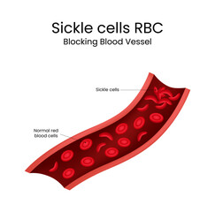 Sickle Cell Anemia Blockage of Blood Vessels