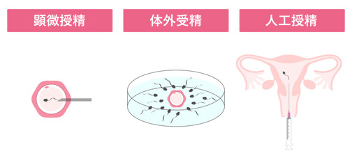 顕微授精_体外受精_人工授精