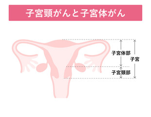 子宮頸がんと子宮体がん