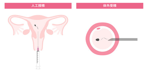 人工授精と体外受精