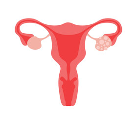 Polycystic ovarian syndrome. Uterus, infertility, gynecology.