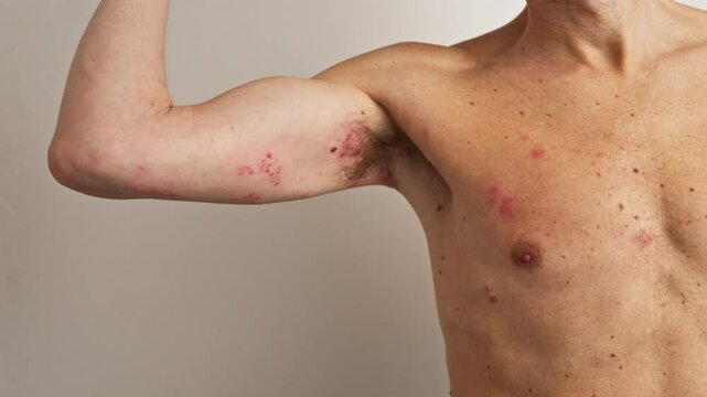 Detailed medical imagery tracking herpes zoster progression, showing shingles rash stages developing across patient's arm and chest against neutral white background