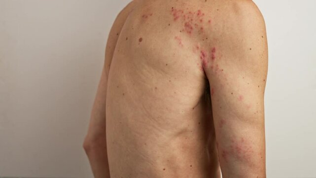 Patient exhibits characteristic rash and blisters associated with shingles, a reactivation of the varicella zoster virus, affecting torso and arm against a neutral background