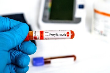 Phenylketonuria - Test with blood sample on shiny blue hand. health or medical concept