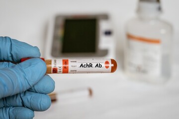 AchR Ab - Test with blood sample on shiny blue hand. health or medical concept