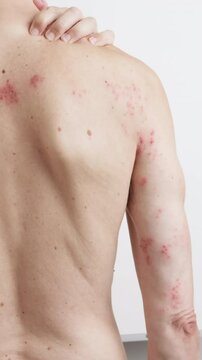Patient presenting painful skin rash and inflamed blisters resulting from herpes zoster virus, demonstrating visible discomfort on white background during medical documentation