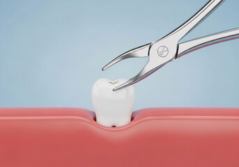 The Process of Tooth Extraction with Dental Forceps, a 3D Health Concept