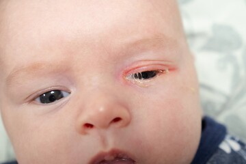 Baby eyes with eye mucus in selective focus. Disease tear ducts tons of newborns close up. Nasolacrimal duct obstruction in baby it is a blockage of the lacrimal drainage system. 