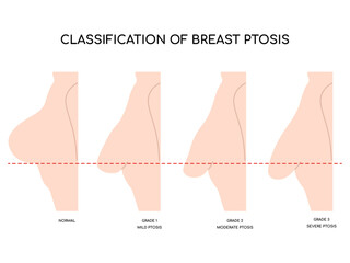 Breast fat transfer lift asymmetrical nipple sag rejuvenate surgery.Sag ptosis correction rejuvenate of breast surgery implantation