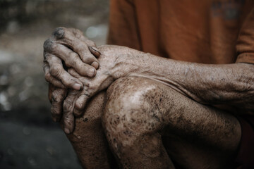 Closeup of wrinkled elderly hands resting on knees, highlighting skin texture, creases, and the...