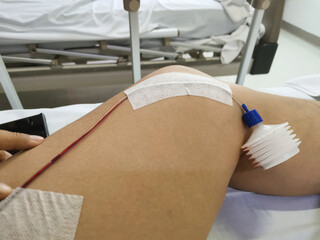 Closeup of the mini vac closed wound suction set on leg.
Medical assistance for rehabilitation...