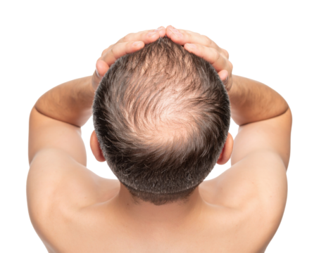 Man covering balding head with hands showing male pattern baldness and hair loss from top view