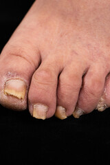 close-up of toenail infection ringworm in human on black background