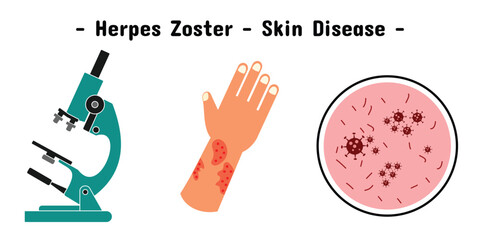 Exposure design of herpes zoster skin disease on the hand and illustration of microscope and virus.