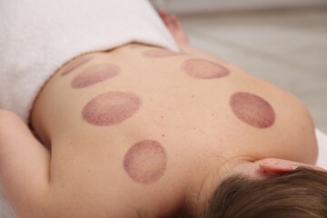 Naklejka premium Woman after cupping therapy in spa salon, closeup