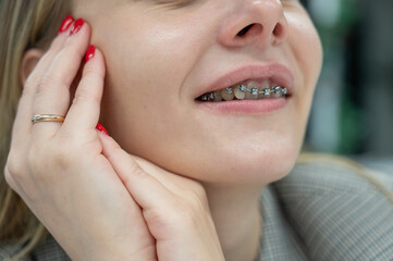 Woman smiling with braces on her teeth. 