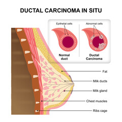 Ductal Carcinoma in Situ illustration