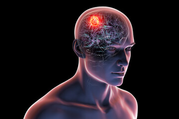 Brain tumor, 3D illustration. Meningioma, glioma, astrocytoma, and other brain tumors