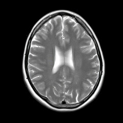 Axial T2-weighted MRI of a 40-year-old showing normal lateral ventricles, corpus callosum, and...