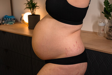 Pregnant woman at 9 months of pregnancy showing stretch marks on belly and leg close up. Body positive. Anticipation getting ready for the maternity